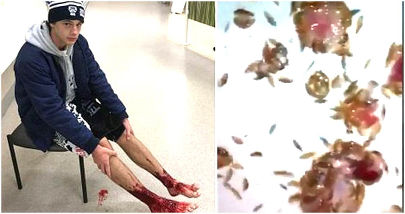 ઓસ્ટ્રેલિયા બીચ પર નાનકડા ‘માંસ-પ્રેમી’ દરિયાઈ  જીવોએ એક કિશોરના પગને ખોતરી ખાધો